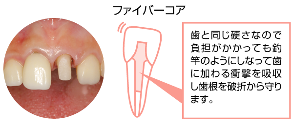 ファイバーコア