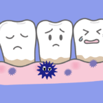 汚れがたまった歯